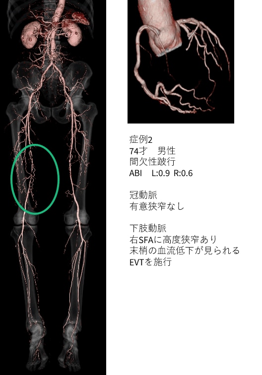 心臓CTを含む複合検査におけるRevolution CTの有用性 ～下肢動脈
